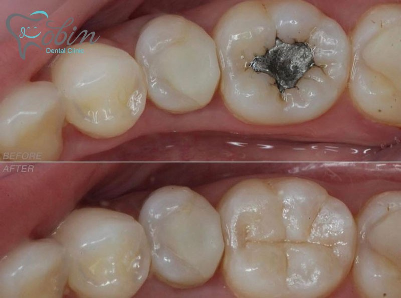 علت پوسیدگی دندان بعد از کامپوزیت 